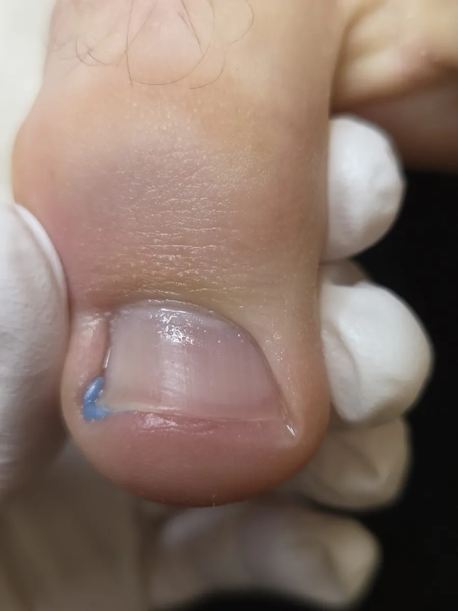 After Treatment