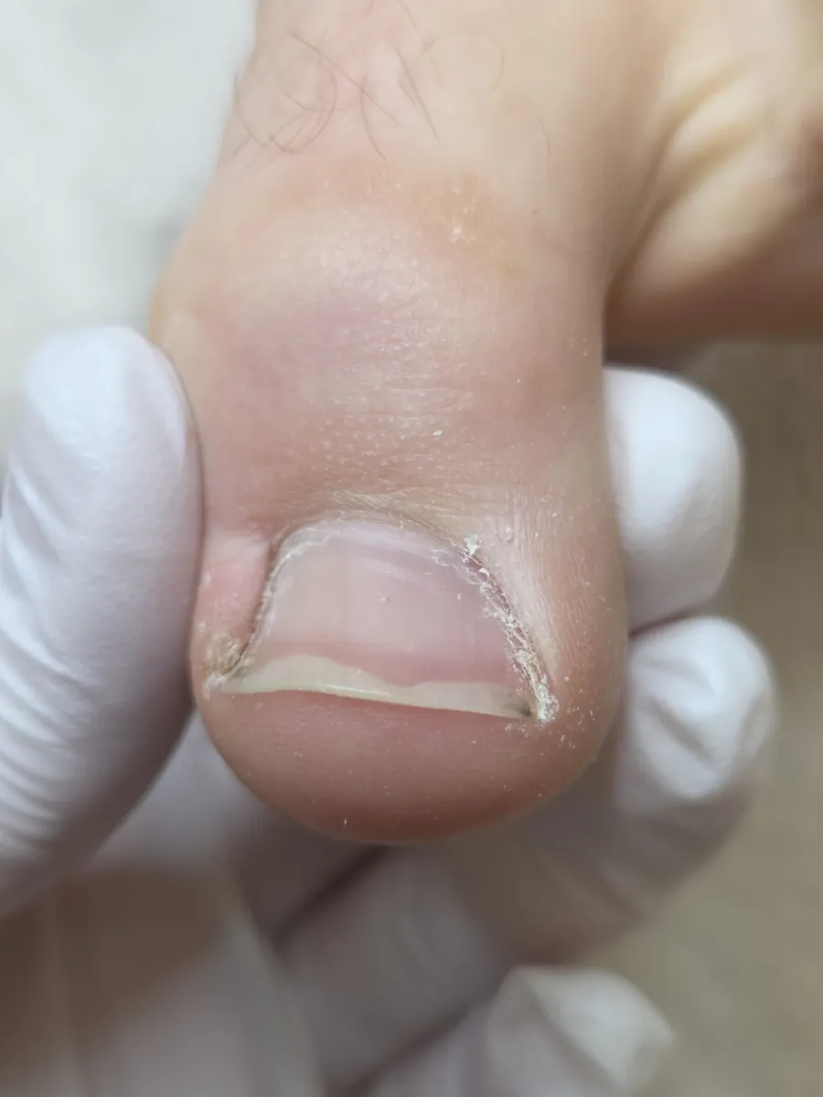 Before Treatment