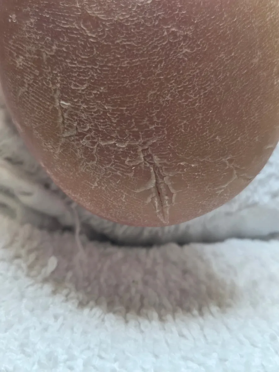 Cracked heel before treatment