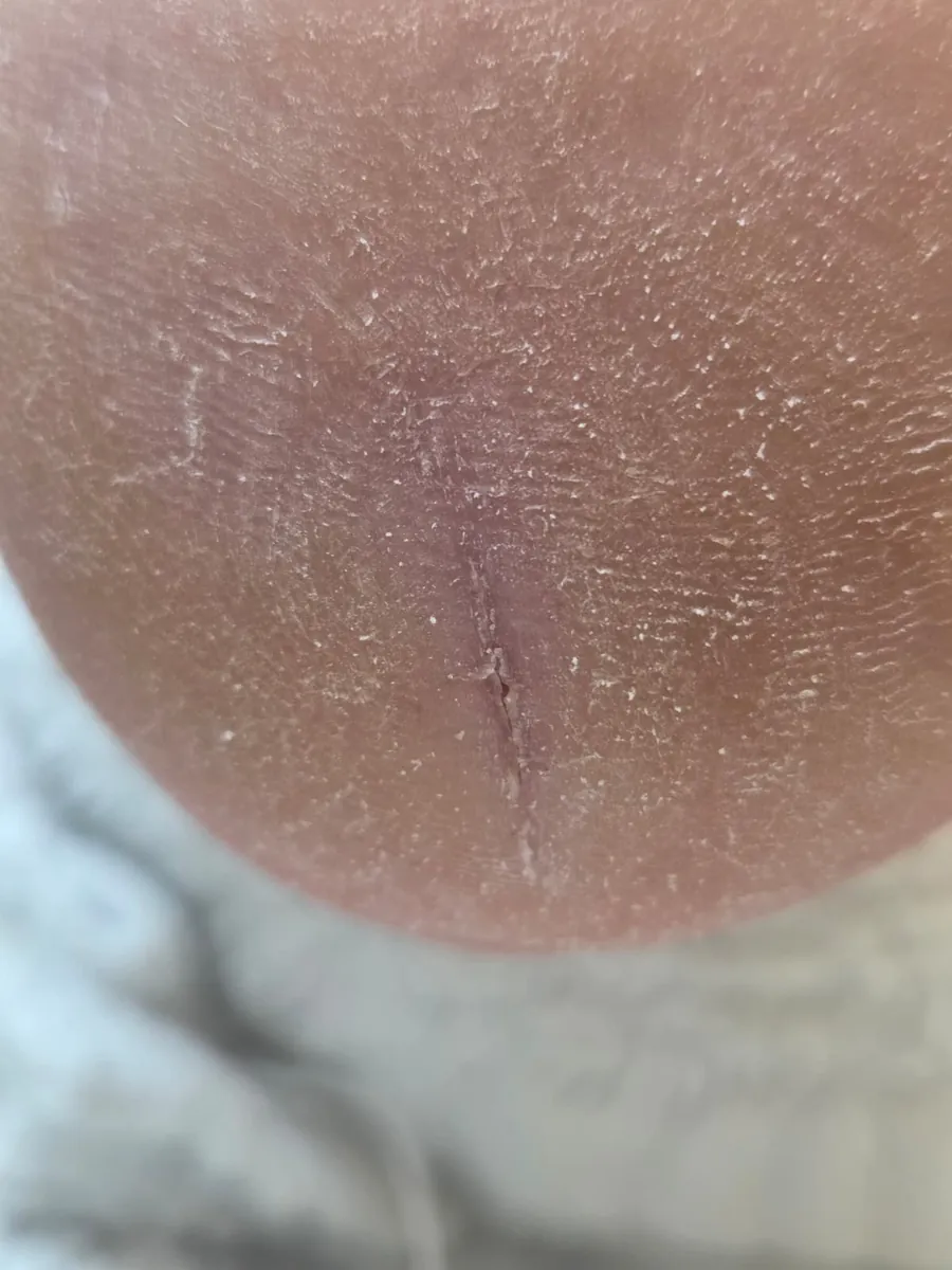 Cracked heel after treatment
