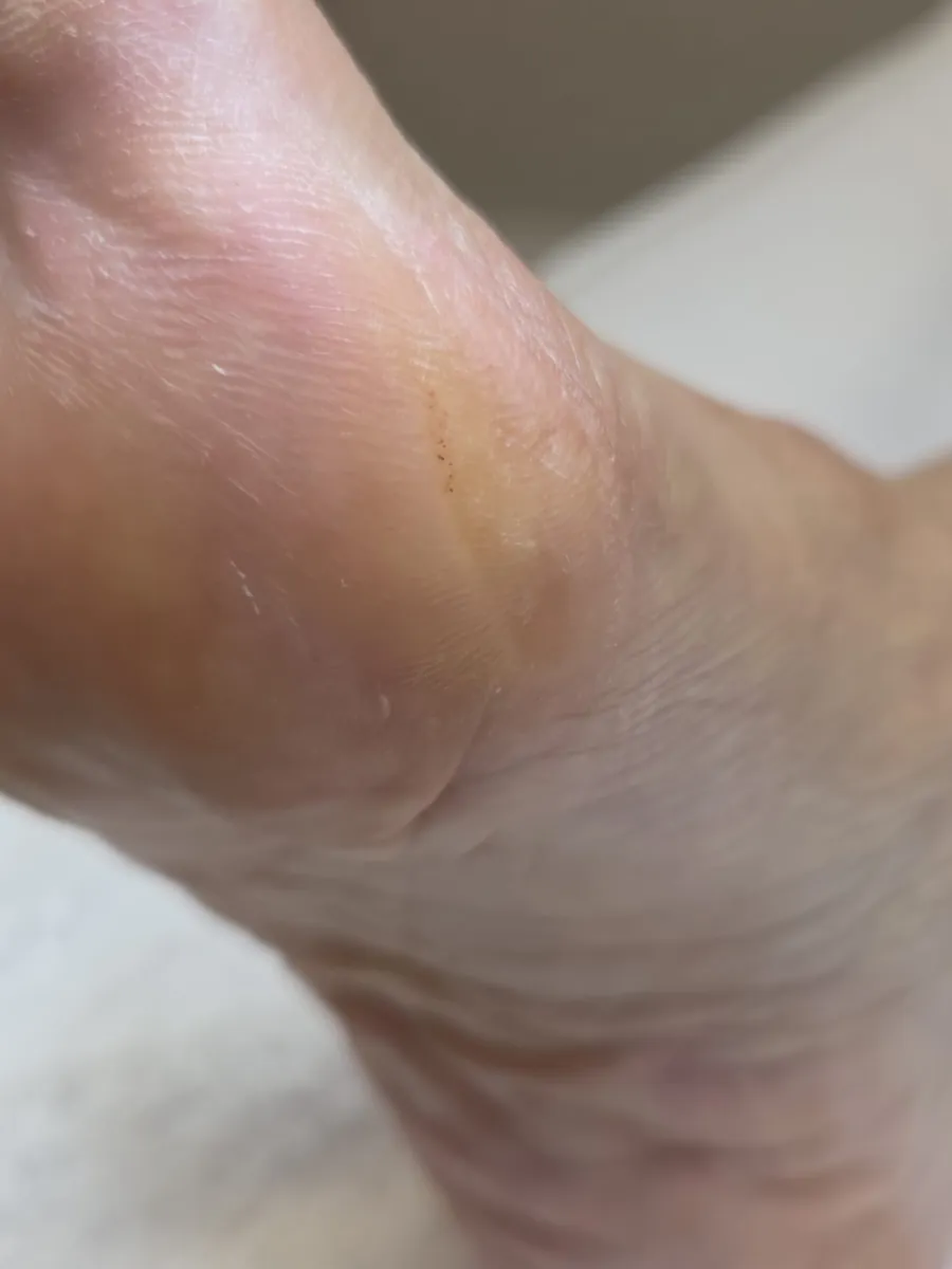 Hyperkeratosis after treatment