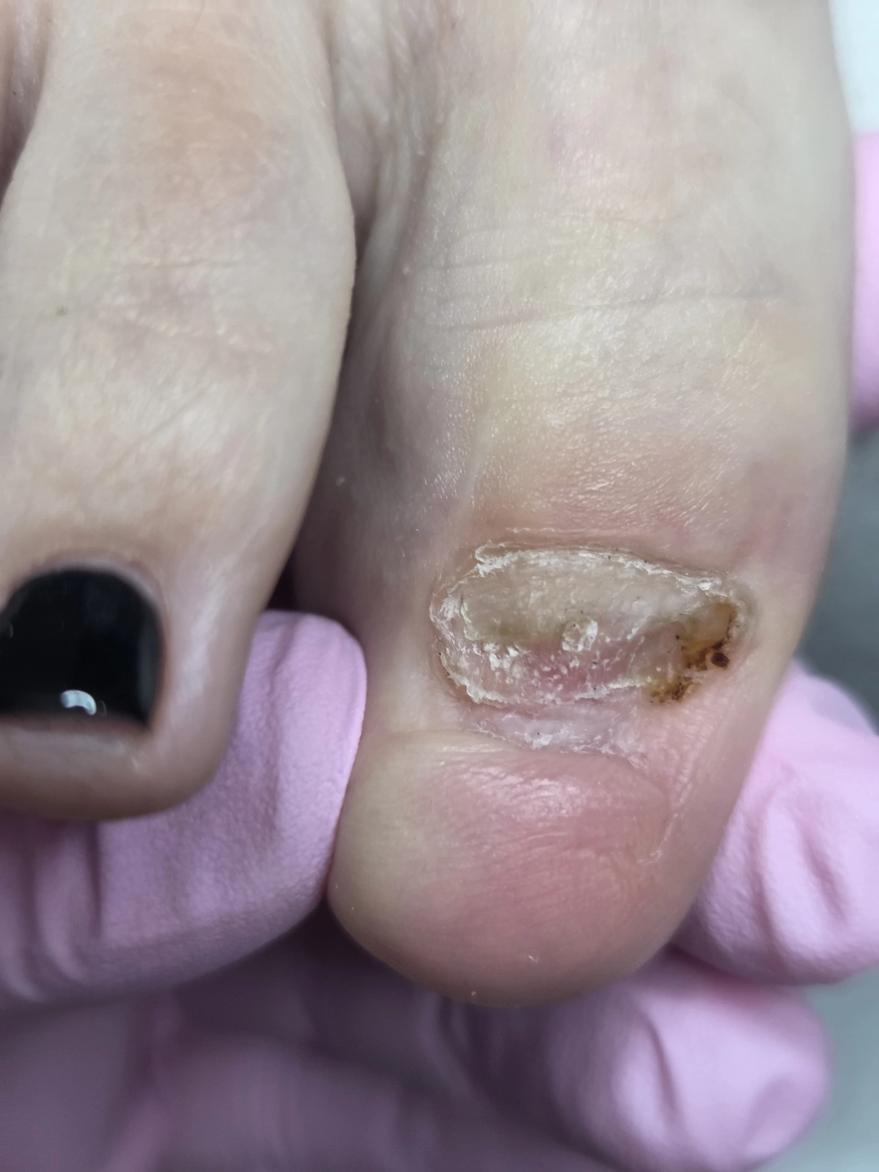 Feet before medical pedicure treatment
