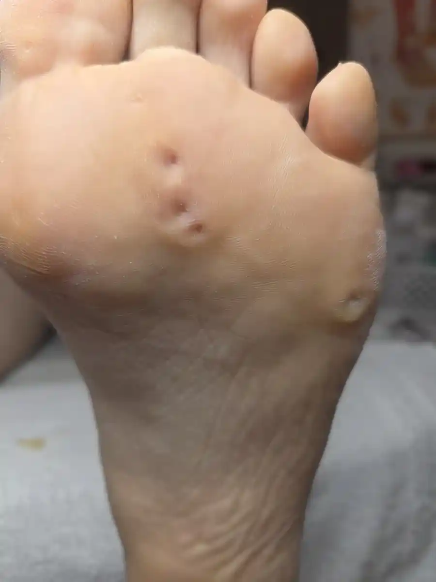 After: hard core corns on the ball of the foot &mdash; after a visit to MediPedi in Troy, MI