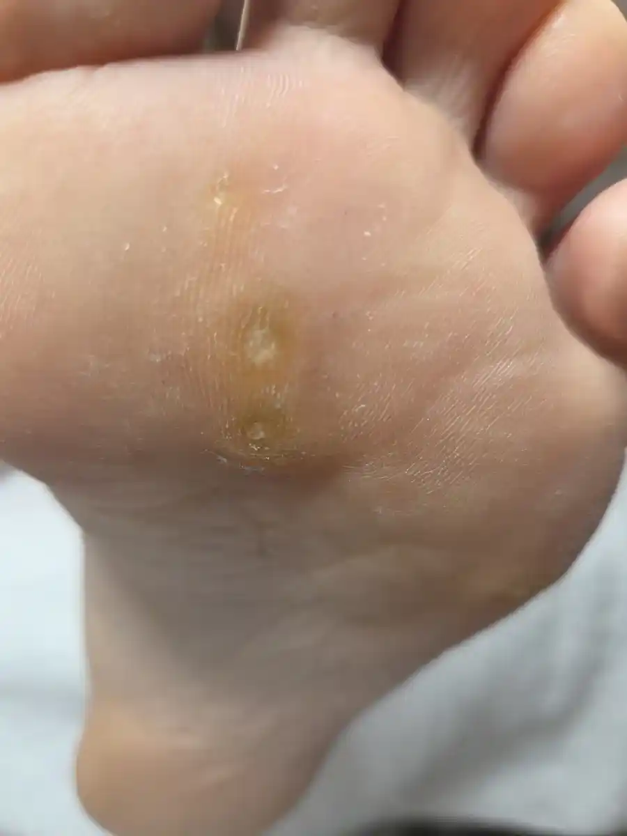 Before: hard core corns on the ball of the foot