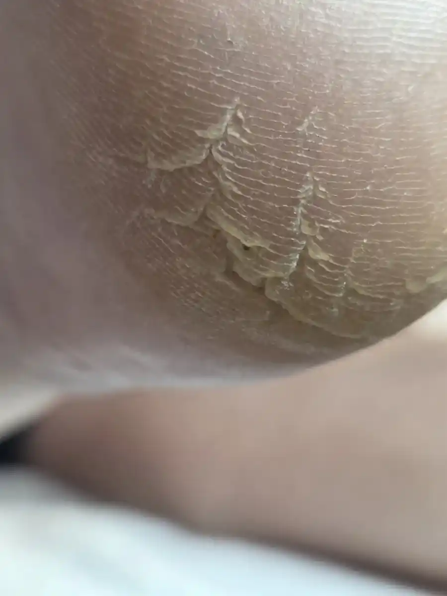 Before: a dry heel with layered, open fissures