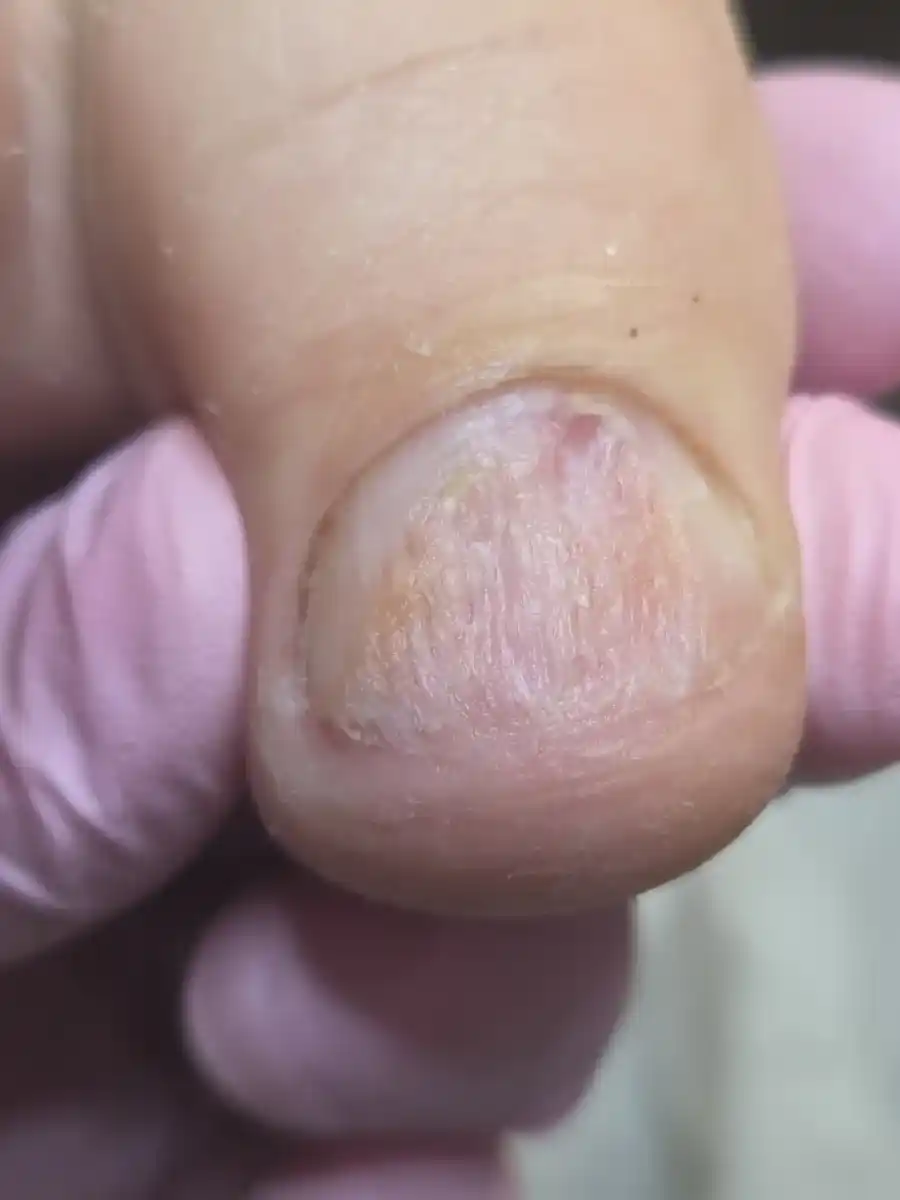 After: a crumbling, yellow, thickened big toenail — after a visit to MediPedi in Troy, MI
