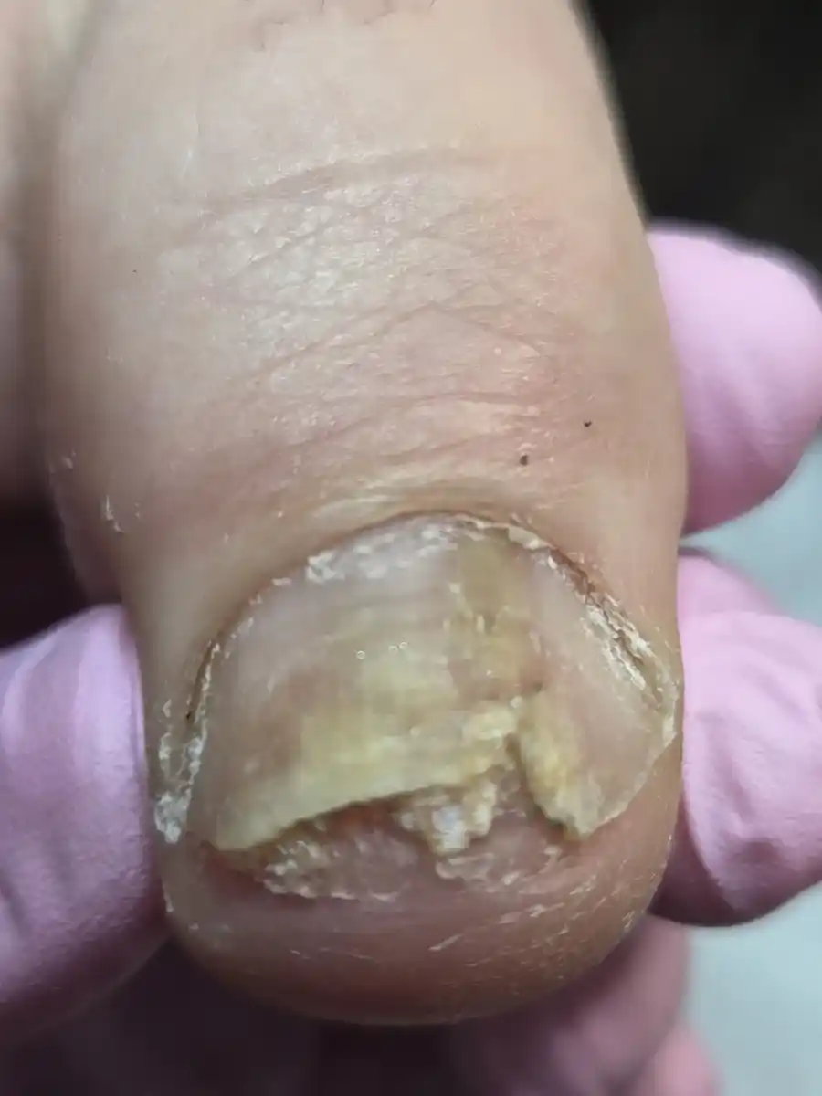 Before: a crumbling, yellow, thickened big toenail