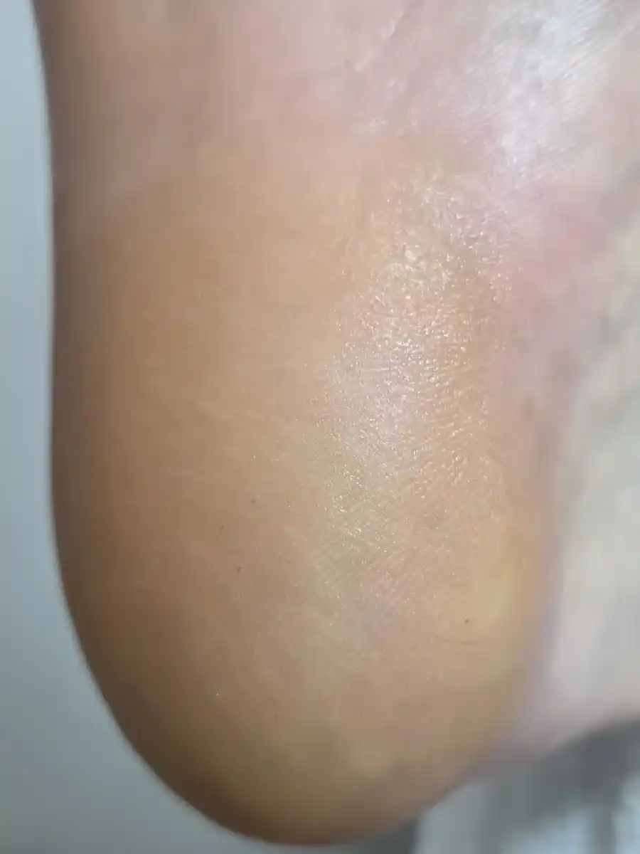After: a thick, yellow, flaking callus on the heel &mdash; after a visit to MediPedi in Troy, MI