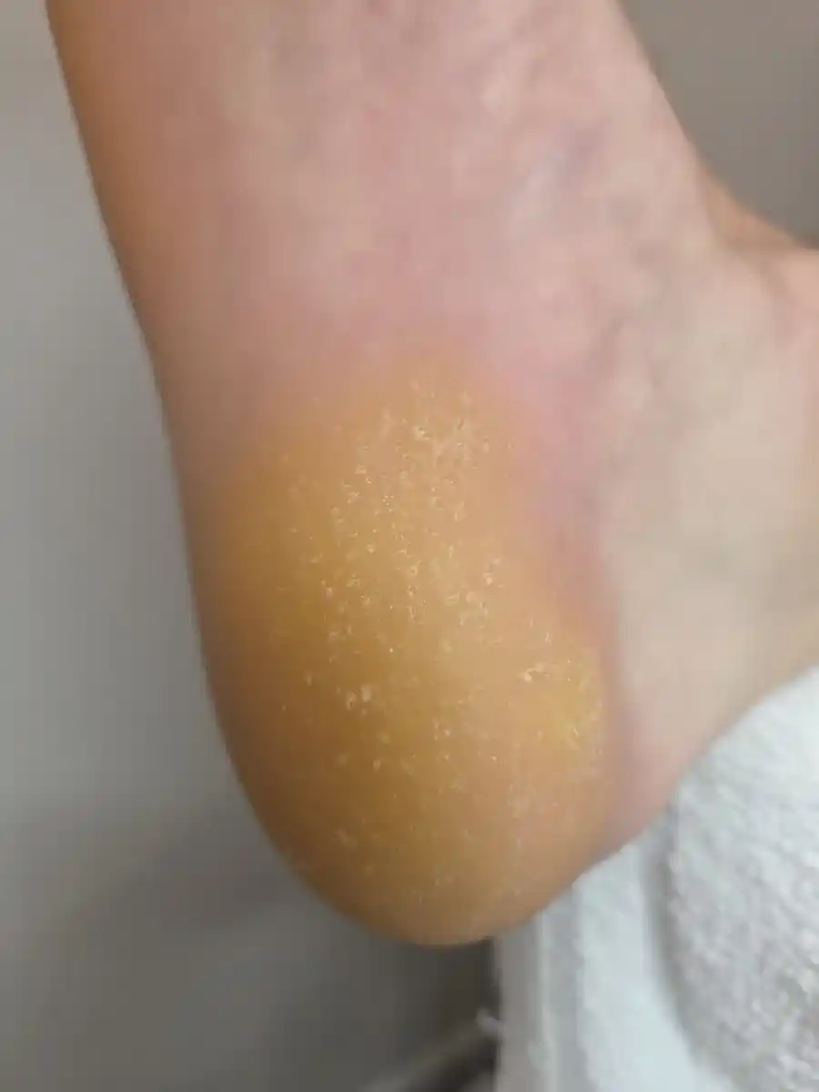 Before: a thick, yellow, flaking callus on the heel