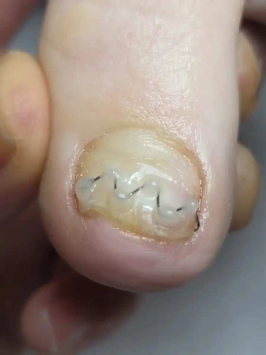 A wire toenail brace fitted on a curved big toenail at MediPedi in Troy, MI