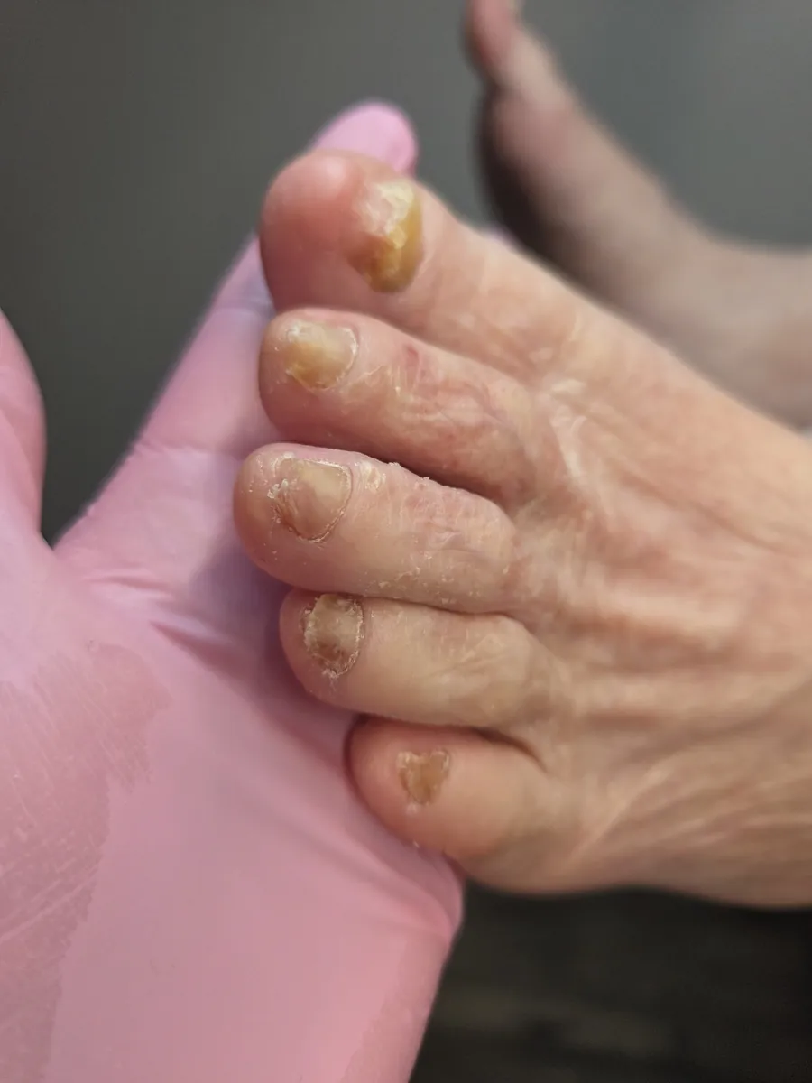 After: long, overgrown, thick yellow toenails curling over the tips of the toes — after a visit to MediPedi in Troy, MI