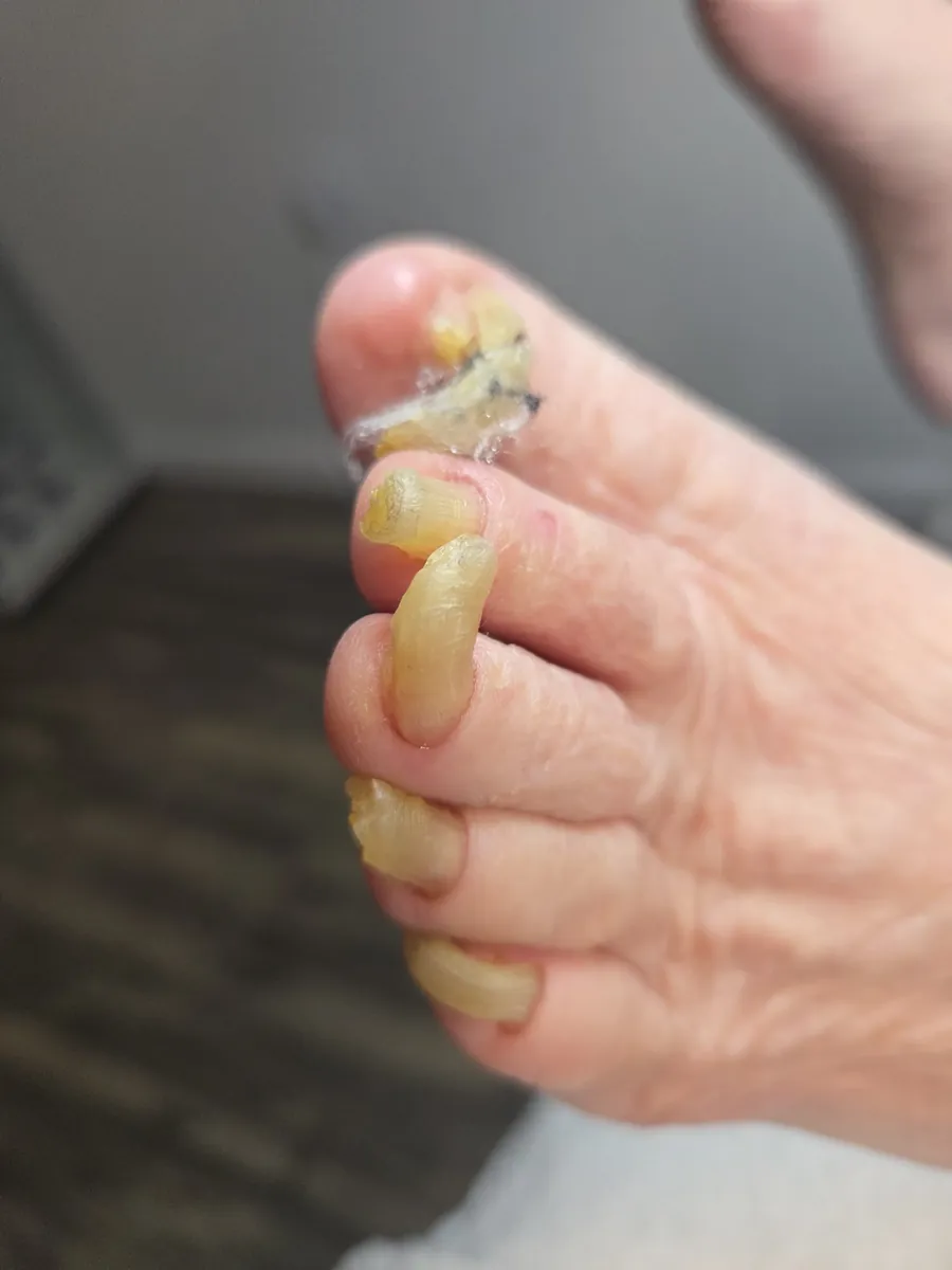 Before: long, overgrown, thick yellow toenails curling over the tips of the toes