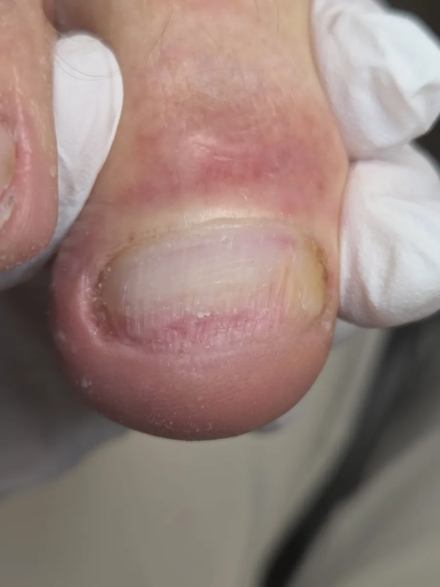 After: a thick, yellow-brown big toenail with ridges and a rough free edge — after a visit to MediPedi in Troy, MI