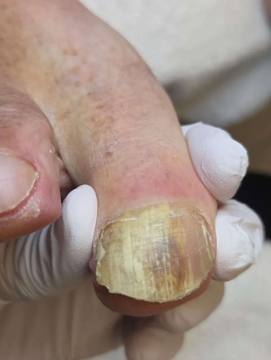Before: a thick, yellow-brown big toenail with ridges and a rough free edge
