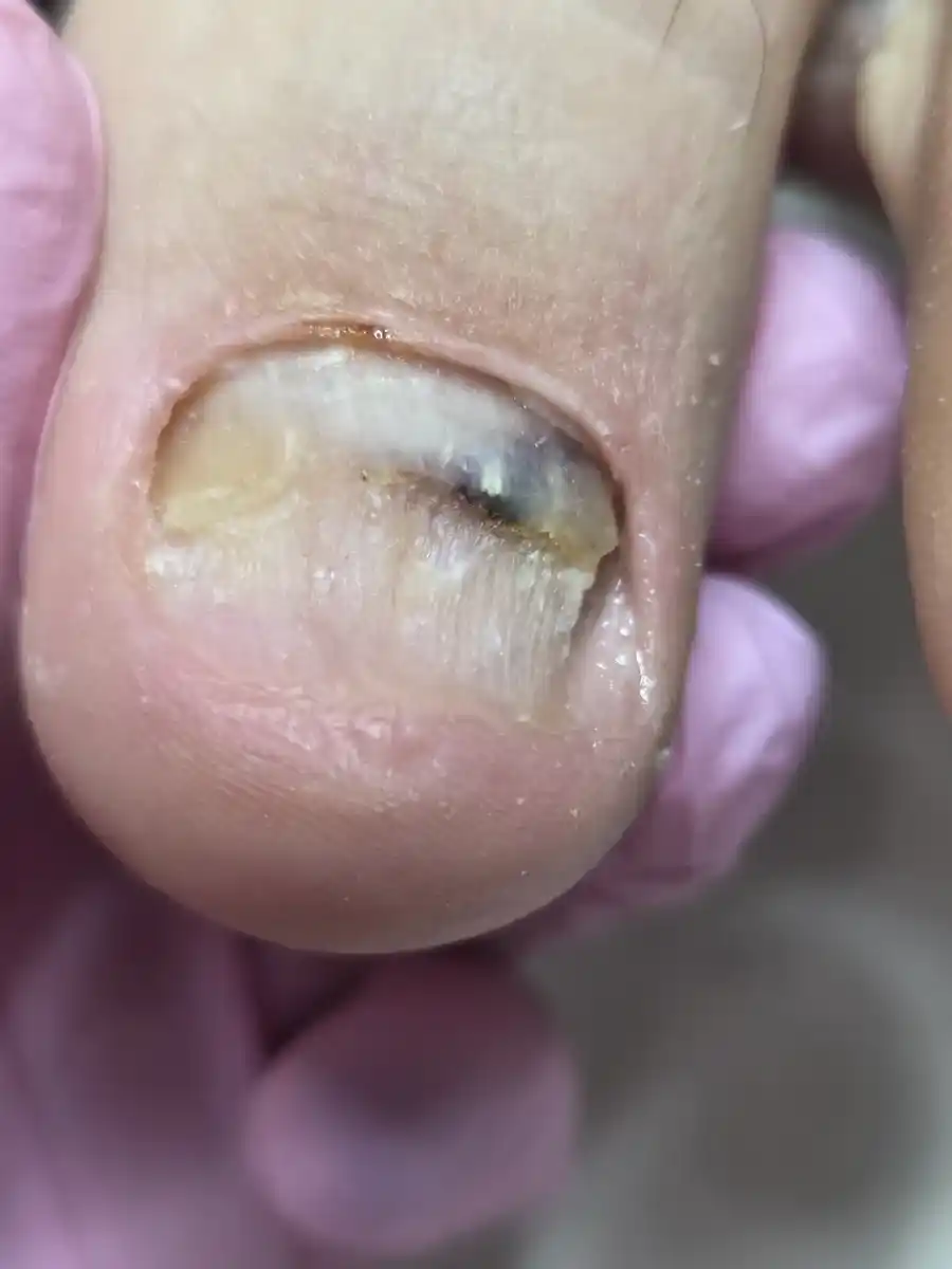 After: a thick, yellow, ridged big toenail with a lifting edge — after a visit to MediPedi in Troy, MI