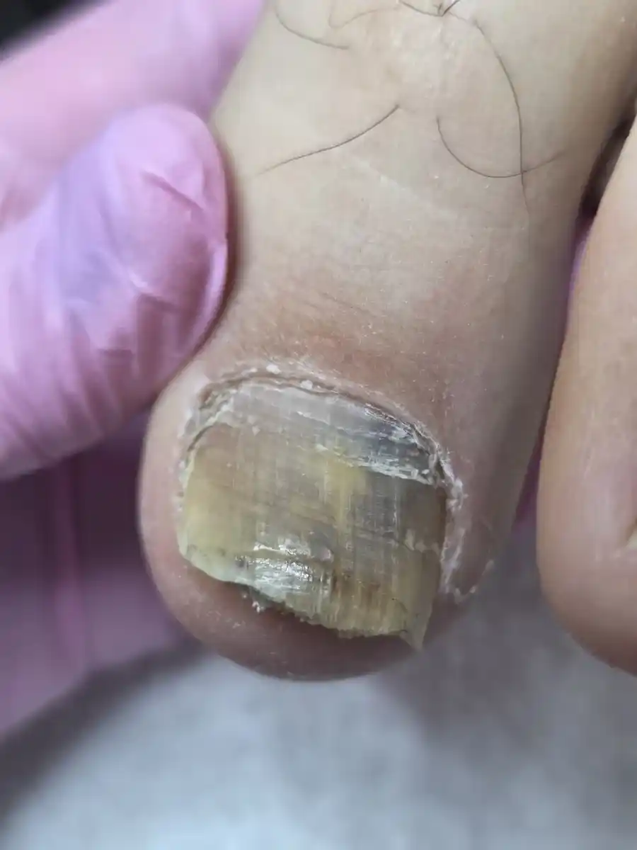 Before: a thick, yellow, ridged big toenail with a lifting edge