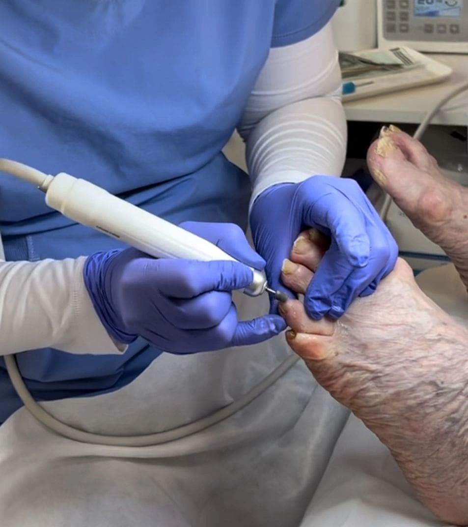 Toenail fungus solution and nail restoration