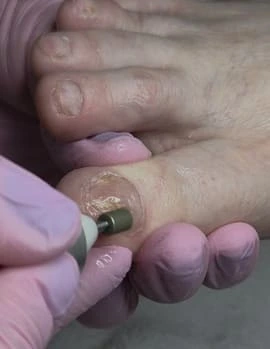 Individual treatment of thickened and deformed nails