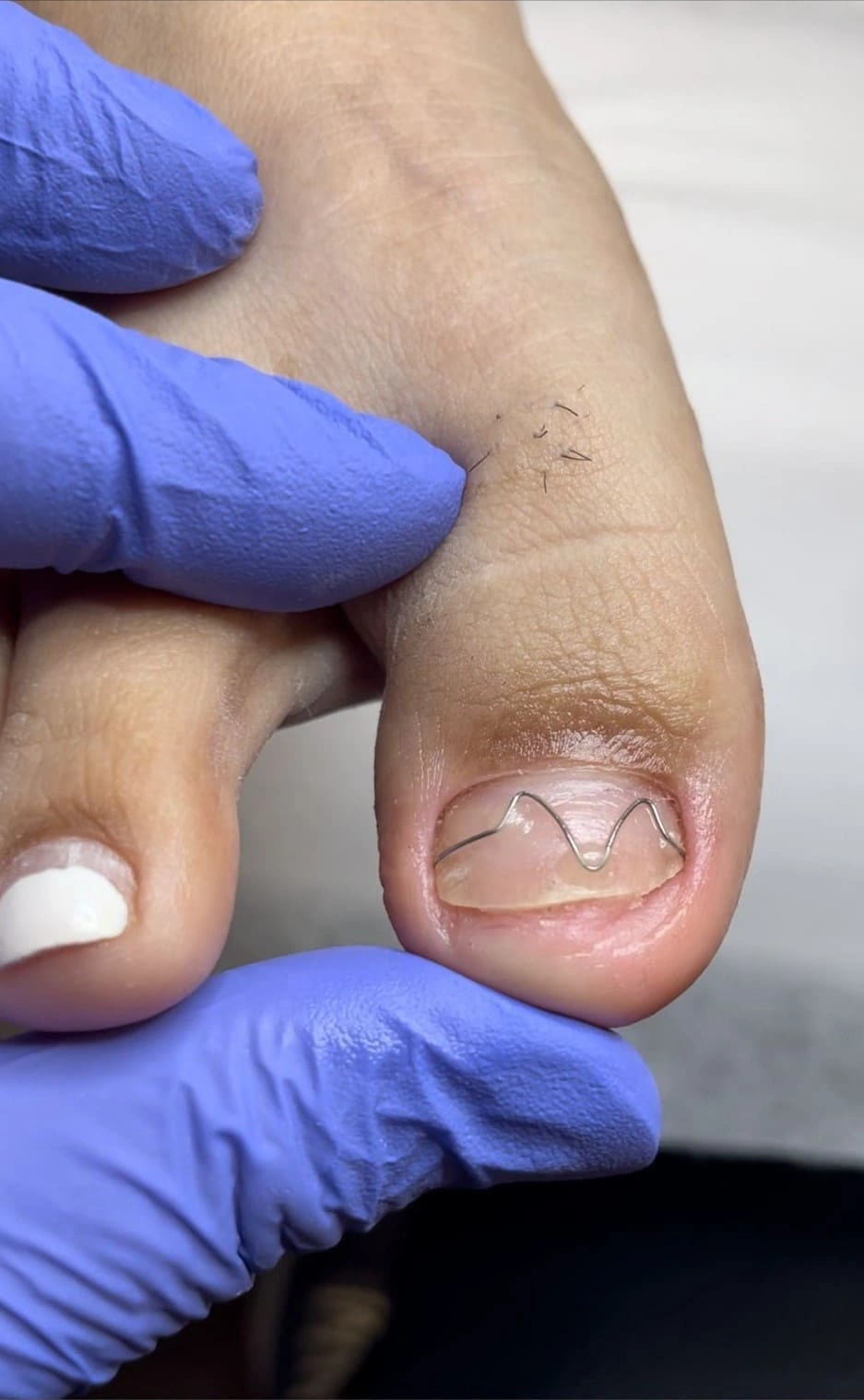 Toenail brace application for ingrown nails